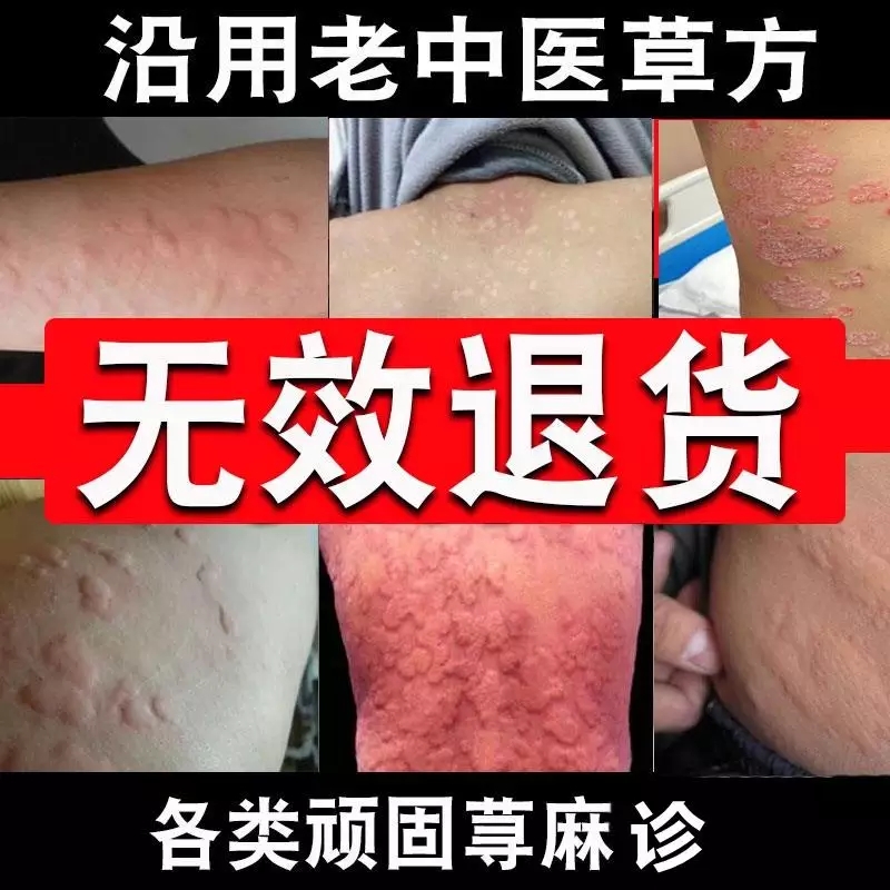 慢性荨麻疹外用药断根风团过敏专用成人皮肤瘙痒止痒中药膏在类目 本地化生活服务, 健康服务, 足浴/洗浴/按摩中 - 来自Buy2taobao.com提供专业的淘宝代购服务