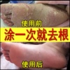 治腳氣去根神器腳氣膏噴劑止癢脫皮治療真菌感染腳臭腳汗泡腳藥包 治腳氣去根神器腳氣膏噴劑止癢脫皮治療真菌感染腳臭腳汗泡腳藥包